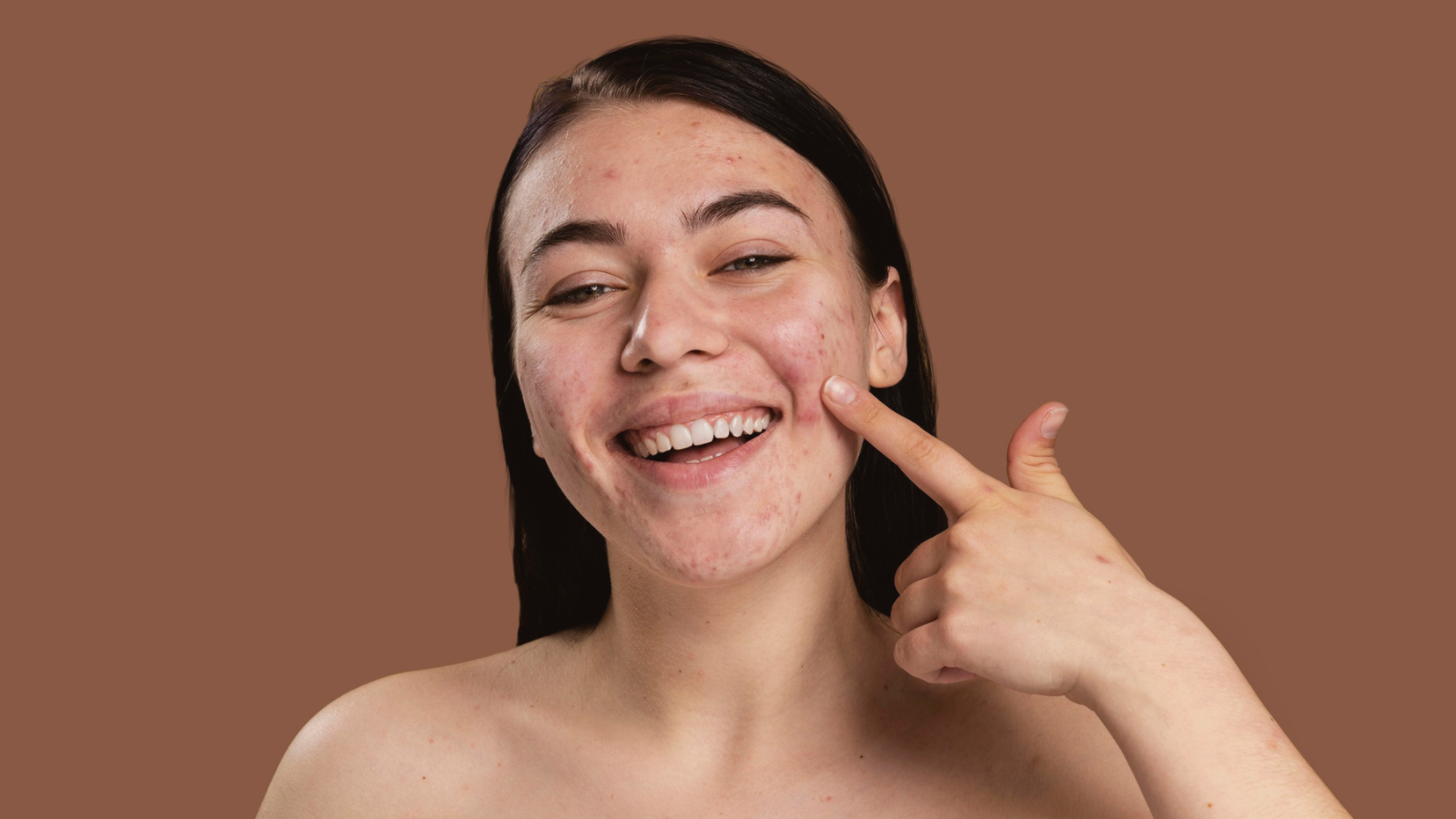 Clear & Confident: Treat Acne Naturally with TRY NATURE